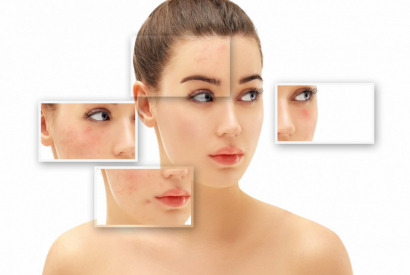 Tout savoir sur le peeling